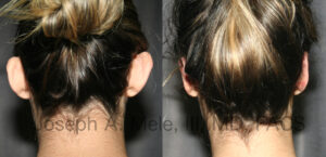Otoplasty Before and After Photos Ear Pinning