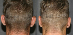 Otoplasty Before and After Photos Ear Pinning