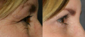 upper and lower eyelid before and after pictures upper and lower blepharoplasty