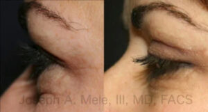 Upper and Lower Blepharoplasty Before and After Pictures Eyelid Surgery