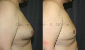 Male Breast Reduction with Liposuction before and after photos pseudogynecomastia