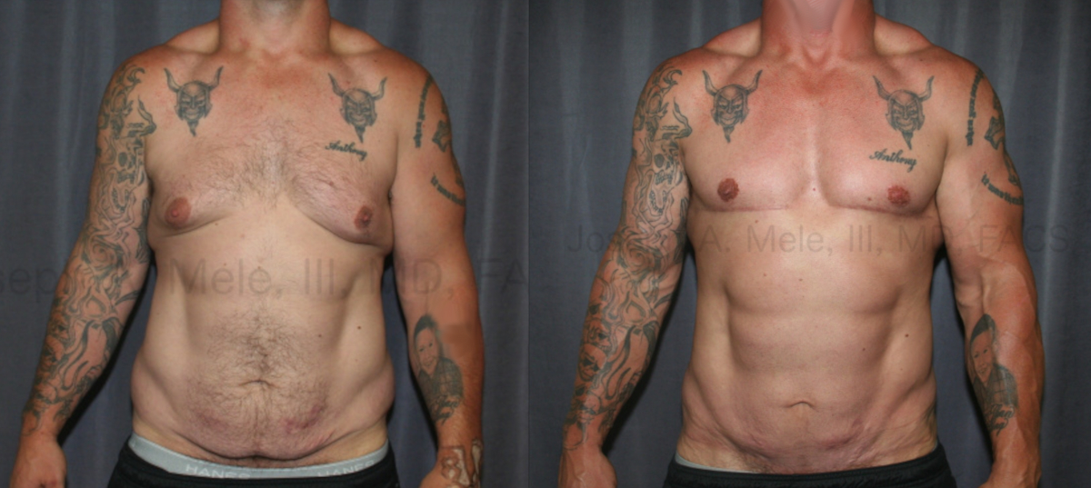 Male Breast Reduction with Liposuction, Excision and Skin reduction before and after photos gynecomastia reduction after massive weight loss.