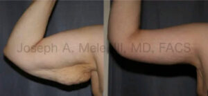 Arm Lift Before and After Pictures (Brachioplasty)