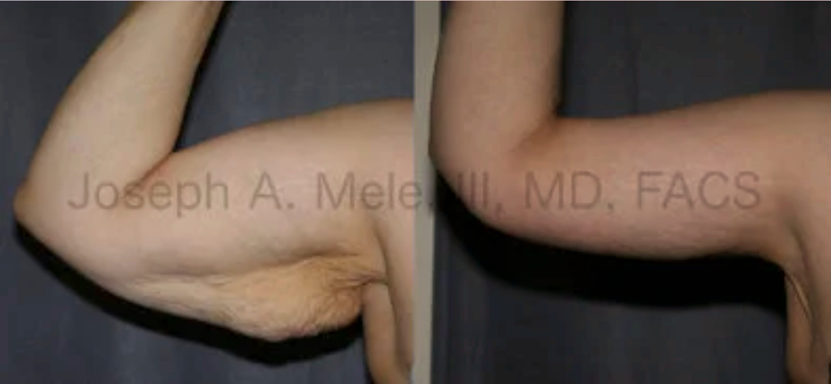 Arm Lift Before and After Pictures (Brachioplasty)